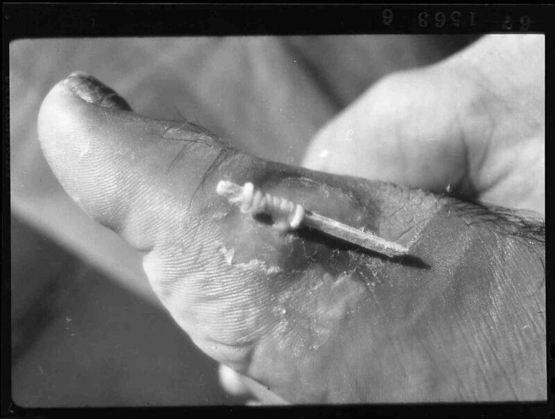 black and white image of a guinea worm being removed from a foot by being wrapped around a stick