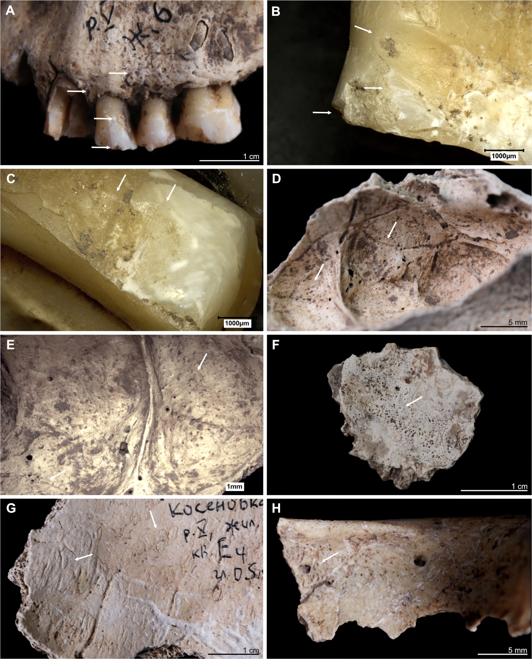 Kosenivka, selection of oral and pathological conditions. A–E: Individual 5/6/+left maxilla. A: Teeth positions 23–26 (buccal view). Signs of periodontal inflammation (upper arrows) and examples of dental calculus accumulation (third arrow) and dental chipping (lower arrow) on the first premolar (tooth 24). B: First premolar (24, mesial view). Interproximal grooving with horizonal striations on the lingual surface of the root (upper arrow) and at the cemento–enamel junction (middle arrow). Larger chipping lesion (lower arrow). C: Canine (23, distal view). Interproximal grooving, same location as on the neighbouring premolar (see B), but less distinct. D, E: Signs of periosteal reaction on the left maxillary sinus (medio–superior view). Increased vessel impressions (D, upper arrow) and porosity, as well as uneven bone surface (D, lower arrow, E), indicating inflammatory processes. F: Individual 2, left temporal, fragment (endocranial view). Periosteal reaction indicated by porous new bone formation (arrow). G: Individual 5, frontal bone (endocranial view). Periosteal reaction indicated by tongue-like new bone formation and increased vessel impressions (arrows). H: Individual 5/6/+, frontal bone, right part, orbital roof (inferior view). Signs of cribra orbitalia (evidenced by porosity, see arrow).