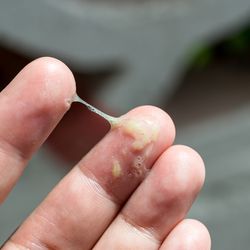 A sick man have a snot on hand. A cold man has snot running on his hand. Mucus on hand.
